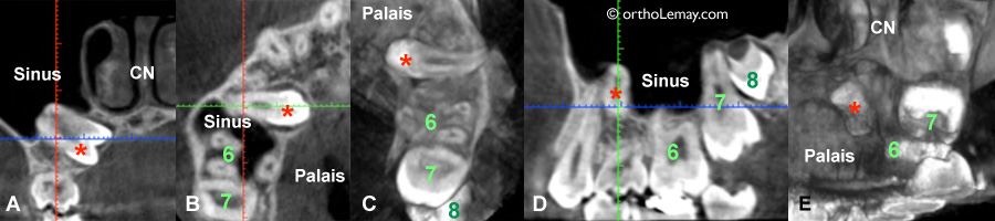CBCT, tomodensitométrie volumique à faisceau conique (TVFC) d'une dent incluse avant la traction orthodontique