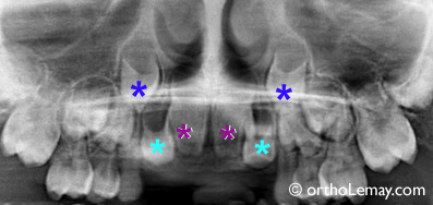 retard-eruption-dentaire-incisive-malocclusion-orthodontie-sherbrooke