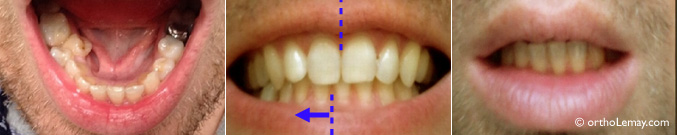 Déviation des lignes médianes et asymétrie des arcades dentaires. Correction en orthodontie 