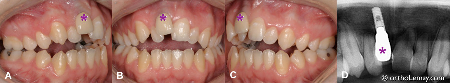 Implant dentaire posé chez un adolescent et contribuant au développement d'une malocclusion avec la croissance résiduelle.