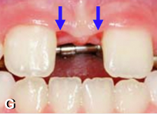 Atherthon's patch ou triangle rouge qui apparait lors de l'expansion maxillaire rapide près des incisives centrales. 