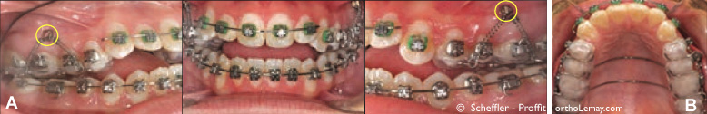 Appareil d'ancrage orthodontique et mini-vis d’ancrage pour correction d'une béance antérieure en orthodontie sans chirurgie 