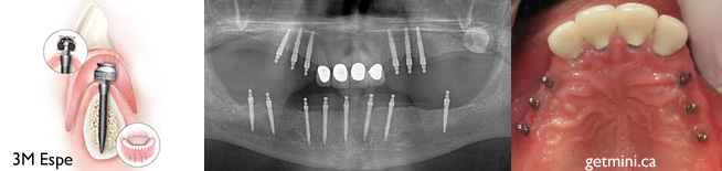 mini-implants dentaires servant à supporter une prothèse dentaire amovible (dentier)