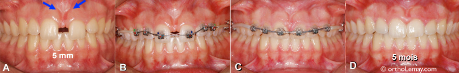 Fermeture d'un diastème de 5 mm en orthodontie en 5 mois.