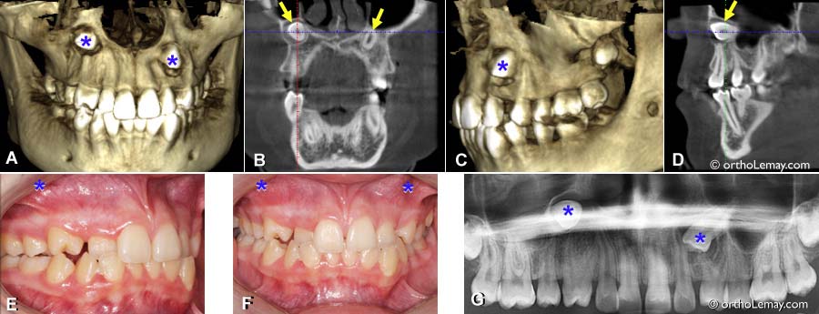 Extraction de canines sévèrement incluses en orthodontie. TVFC et radiographies indiquant la position des canines