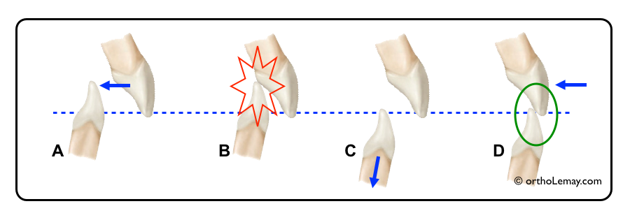 La rétraction ou le recul des dents antérieures ne peut se faire sans modifier le surplomb vertical.
