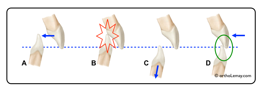 La rétraction ou le recul des dents antérieures ne peut se faire sans modifier le surplomb vertical. 