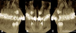 Canines incluses et ectopiques | Bücco