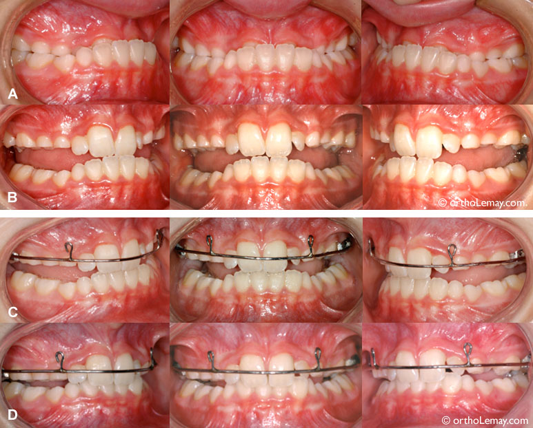 Masque Orthodontique Dentaire BOMAOER Type Tirage Avant/arbre/centre - Couleur Rose - Neuf Sous Emballage