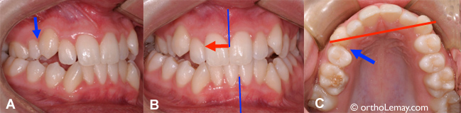 Extraction contributing to a dental malocclusion