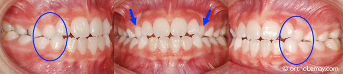 Orthodontie Remonter Dent  . Un Traitement Orthodontique Doit S�accompagner D�une L�orthodontie Consiste À Déplacer Les Dents Et À Modifier La Croissance Des Mâchoires, Afin D�obtenir.