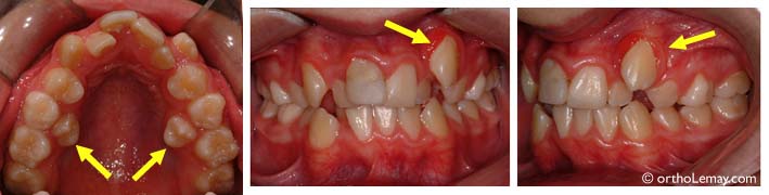 L Eruption Dentaire Normale Et Problemes Bucco