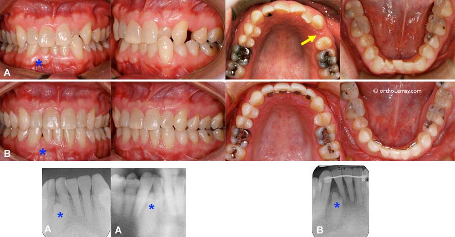 Invisalign : Orthodontie et appareil dentaire invisible - GUIDE