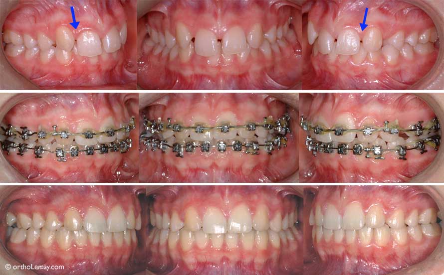 If a canine replaces a lateral incisor, its crown must be reshaped or modified so it looks as much as possible like a lateral incisor