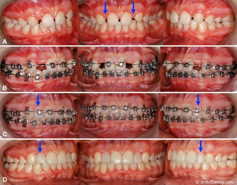 (A) Both upper lateral incisors are missing (anodontia) (arrows). (B) Opening of the spaces for the lateral incisors orthodontically to eventually replace them by implants. (C) During the treatment, with artificial teeth added on the "braces" for improved esthetics. (D) At the end of the treatment, teeth are added to maintain the width of the space until implants and final crowns are installed. The esthetics of these crowns will be better than the temporary teeth in place.