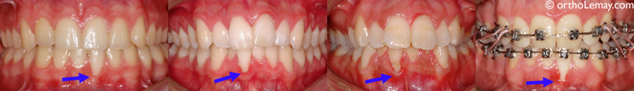 Gingival recession and orthodontics