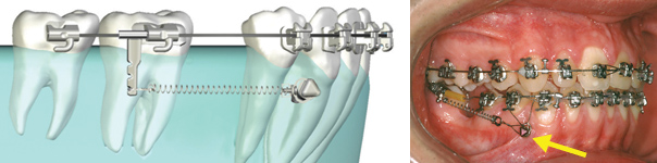 mini implant dentaire prix mini implant dentaire prix