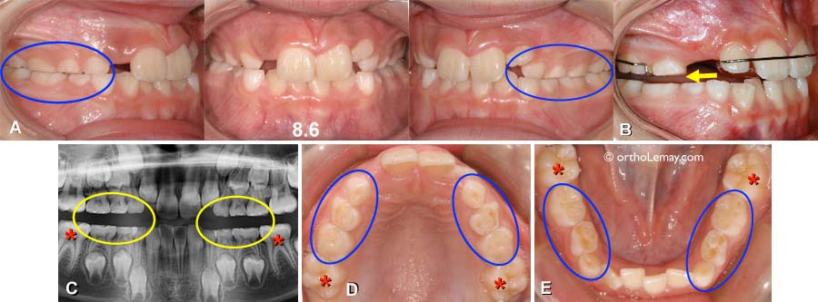 Usure Dentaire Suite Bucco