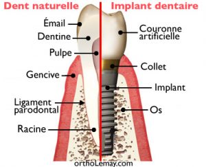 Comparison between a natural tooth and a dental implant.