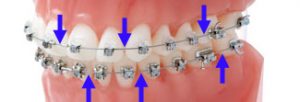 Tube croisé à sertir orthodontique dentaire, double tube pour fils