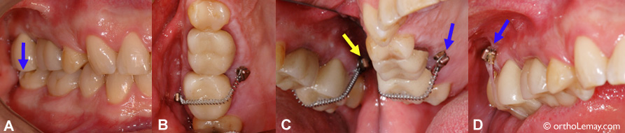 Implant Dancrage Temporaire Orthodontique Mini Vis Bücco - 