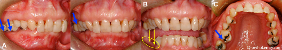 Éruption excessive de dents à la suite de la perte de molaires.