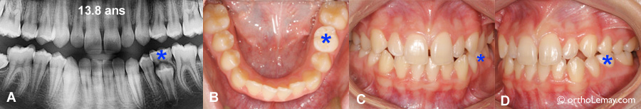 Dentition avec dent de lait (dent temporaire) et prête à débuter un traitement d'orthodontie