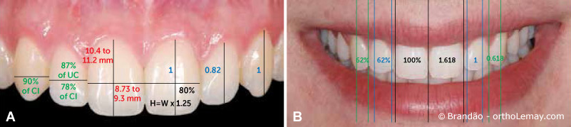 Évaluation de la dimension et forme des dents pour optimiser l'esthétique. 