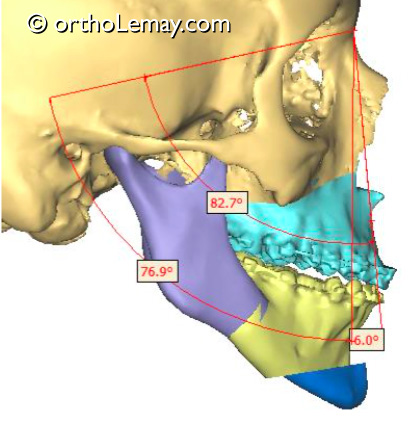 Simulation d'un traitement de chirurgie orthognathique et d'orthodontie pour corriger une rétrognathie mandibulaire.