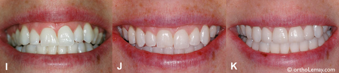 Sourire gingival corrigé par l'orthodontie et des facettes