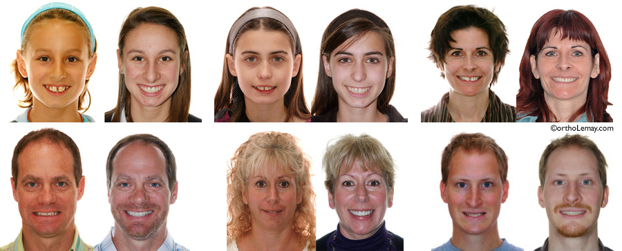 Exemple de corrections orthodontiques et de modification du sourire chez des adolescents et adultes
