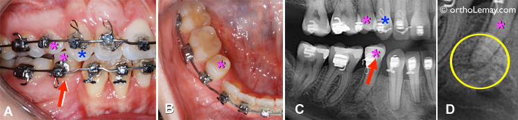 Traumatisme dentaire occlusal et mobilité dentaire, causé par une surocclusion.