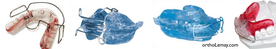Appareil fonctionnel orthodontique Bionator Balters pour correction de rétrognathie mandibulaire en croissance