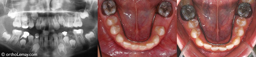 Serial extractions and the use of a lower space maintainer have helped the permanent teeth erupt in a better position without losing space.