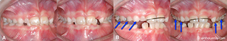 Bite plane for dental disclusion in orthodontics