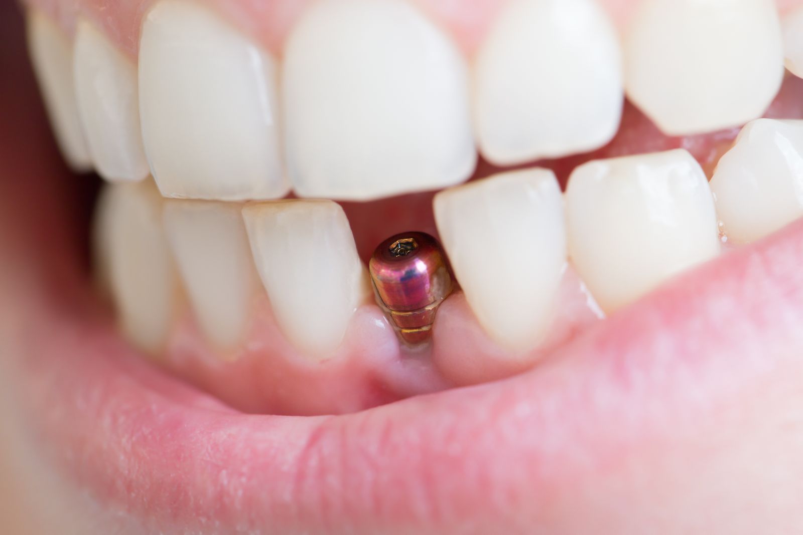implant dentaire en bouche