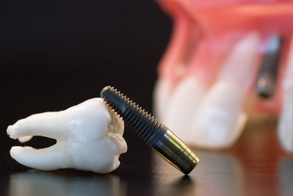 L’implant dentaire, une solution avantageuse
