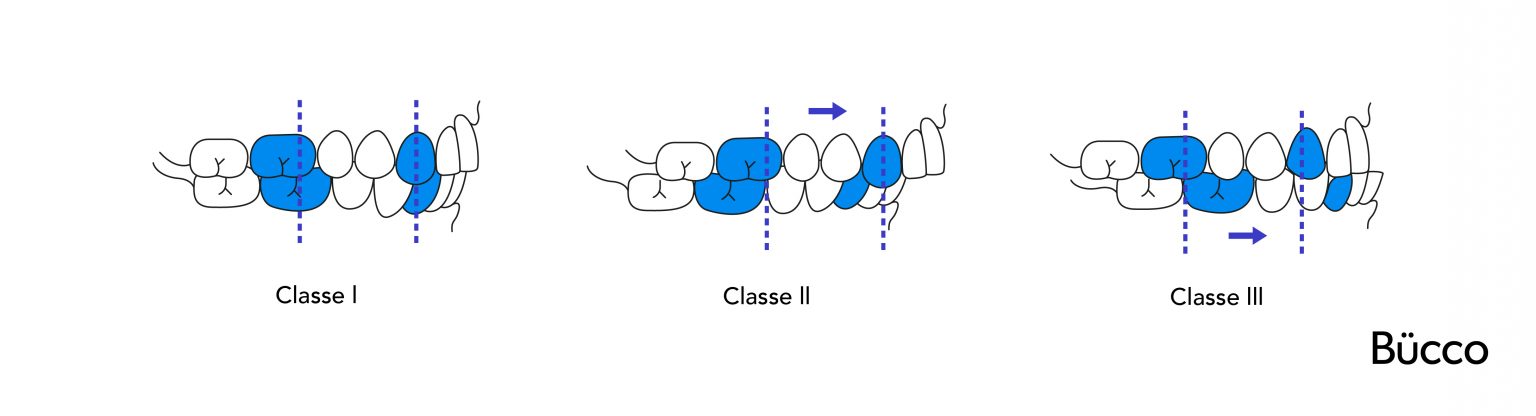 Mainteneur D'espace Lingual Universel Orthom - Maille 1.2mm, Lot De 2 Pièces